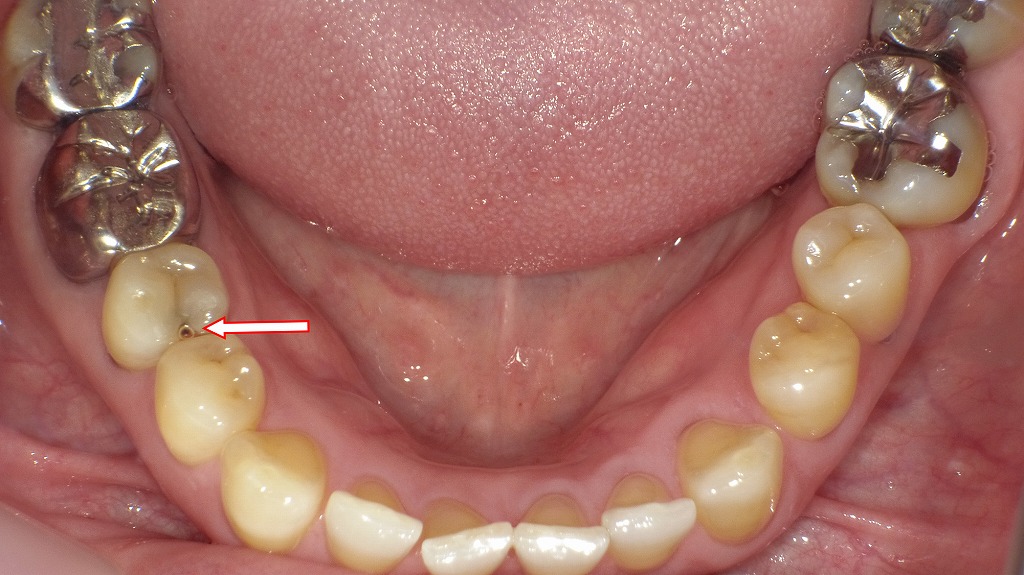 虫歯による穴：症例2 下顎５番の虫歯