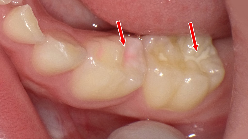奥歯の深い溝は虫歯になりやすい場所。シーラントで溝をコーティングすることで、汚れのたまりを防ぎ、虫歯予防につながります（矢印部）。