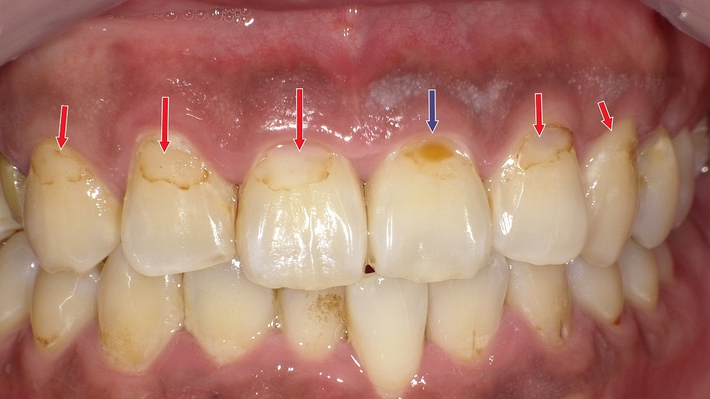 経年劣化したコンポジットレジン修復:変色・褐線・脱離の発生例