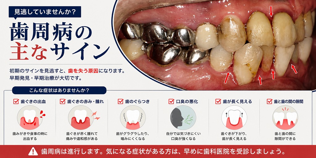 歯周病で歯ぐきが自然に出血する状態とは｜進行した炎症のサイン