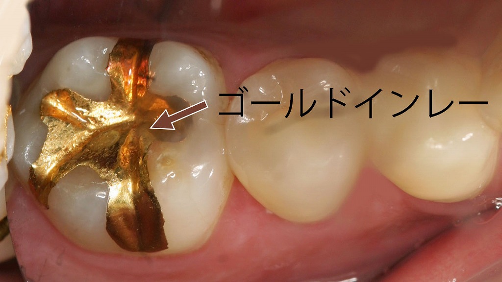 ゴールドインレーによる修復（自費診療）