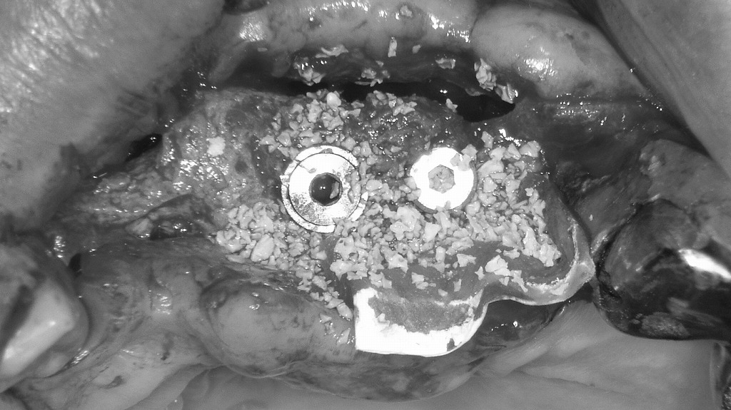上顎前歯欠損に対するインプラント埋入と骨造成