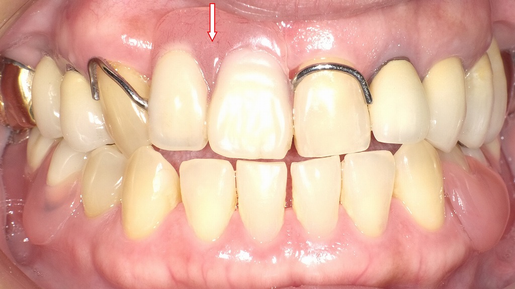 保険適用の部分入れ歯(局部義歯)
