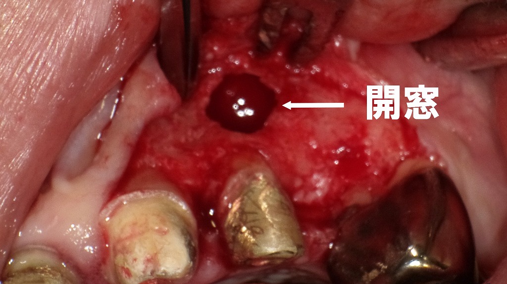 上顎犬歯部における歯根端切除術のための開窓