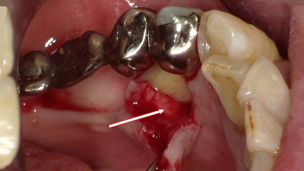 フラップ手術（歯肉剥離掻爬術）