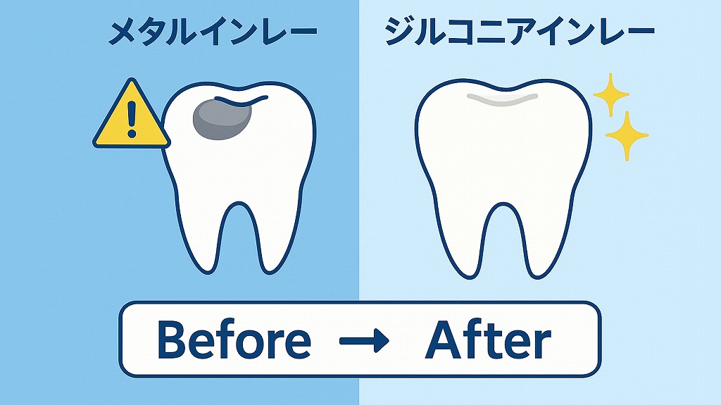 ジルコニアインレーとは？