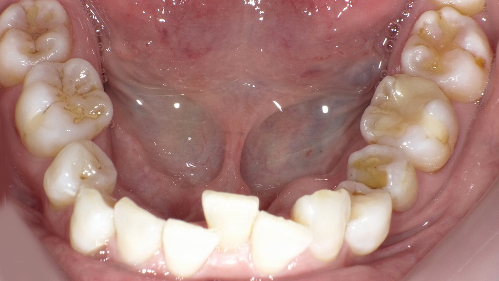 下の前歯の軽度の歯列不正(成人)