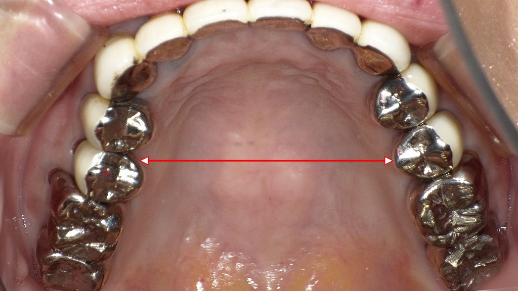 保険適用の被せ物の症例：咬合面観