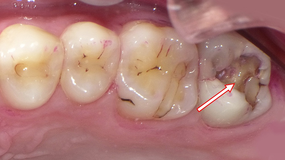上顎第2大臼歯(7番)に虫歯の痛みがある症例