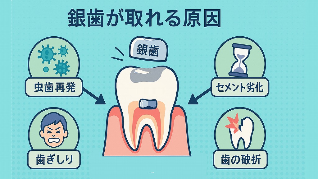 銀歯が取れる主な原因
