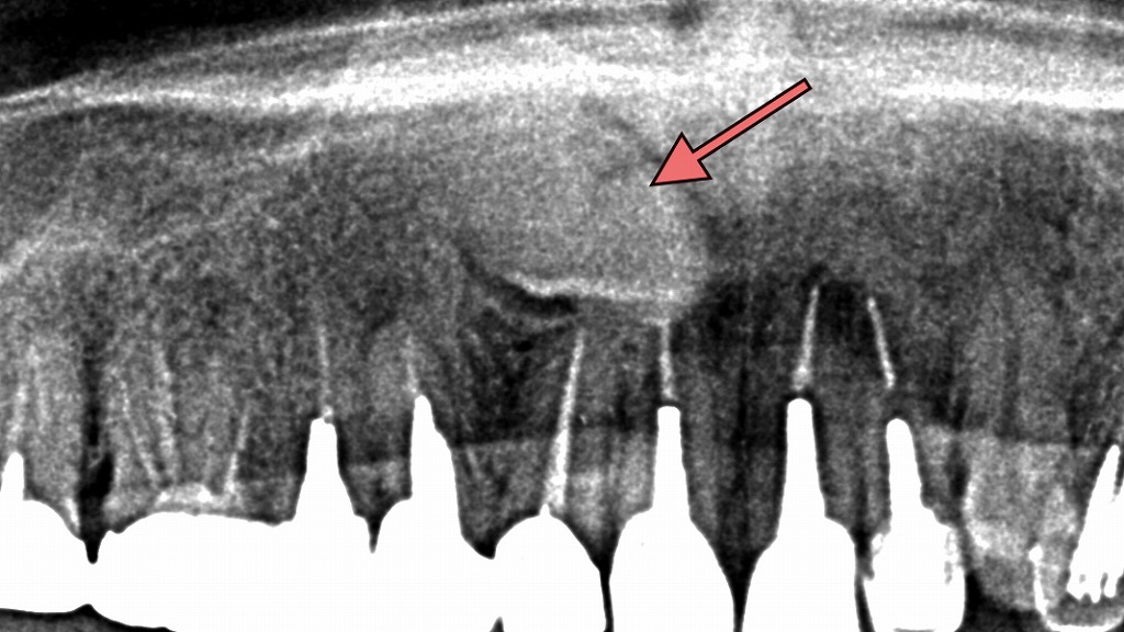 犬歯が埋伏歯となったレントゲン画像