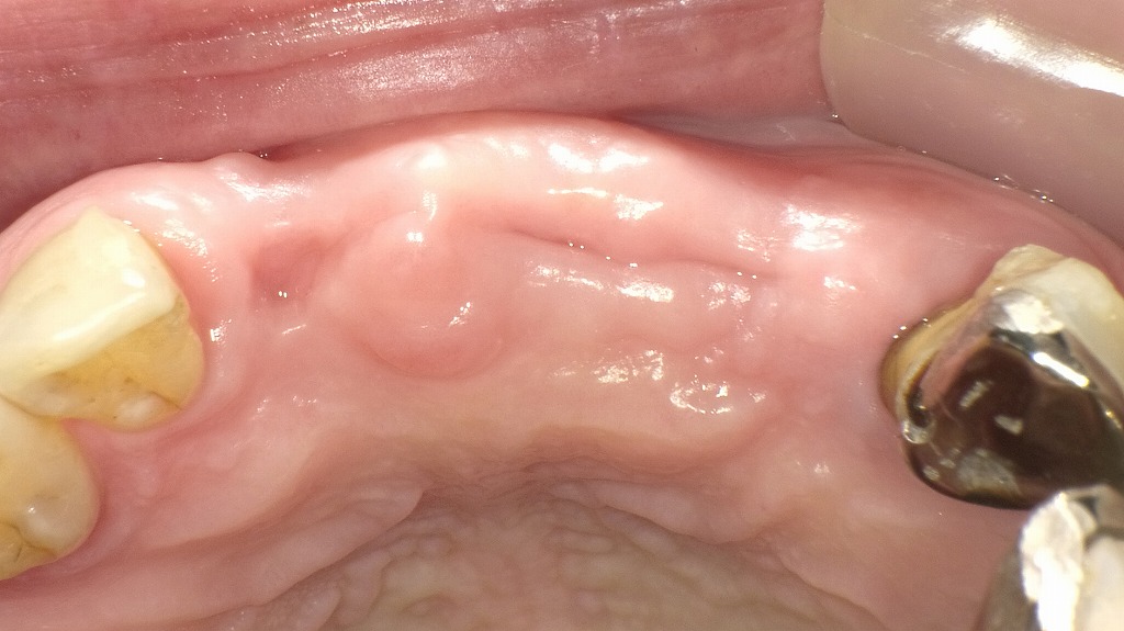 上顎前歯部の欠損に対する治療アプローチ