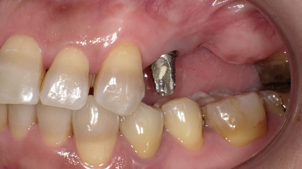 寿命を迎えた差し歯に対するインプラント治療計画（上顎小臼歯・大臼歯部）