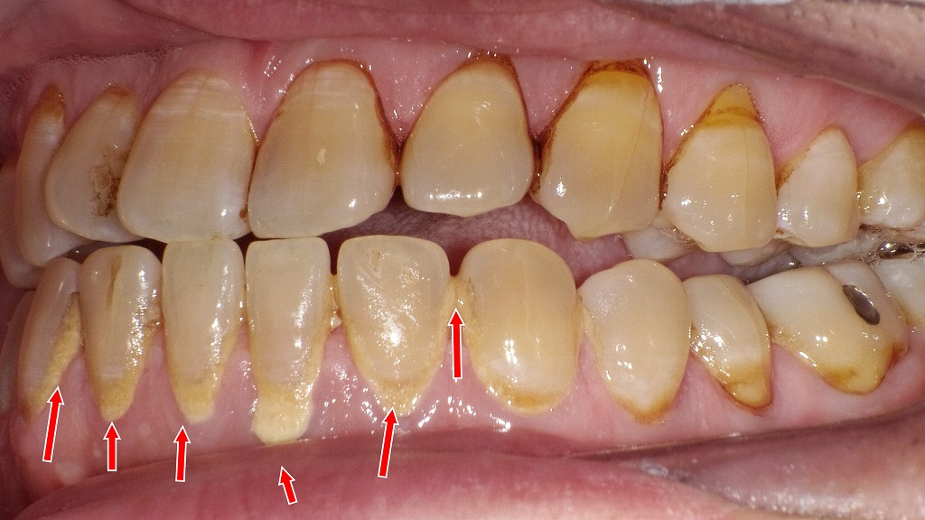 縁上歯石の多発例：左側面観