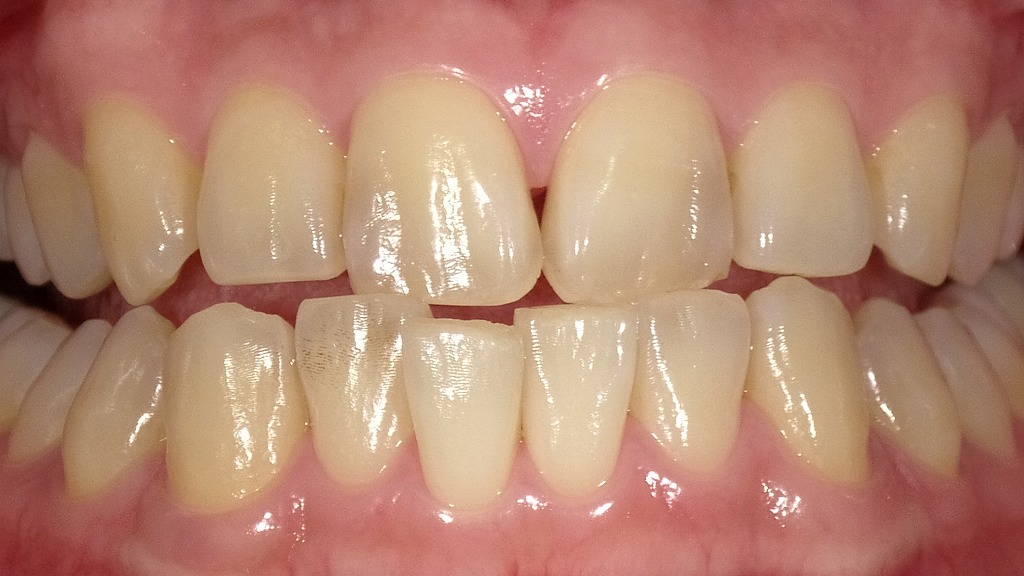 1枚目：ホワイトニング前