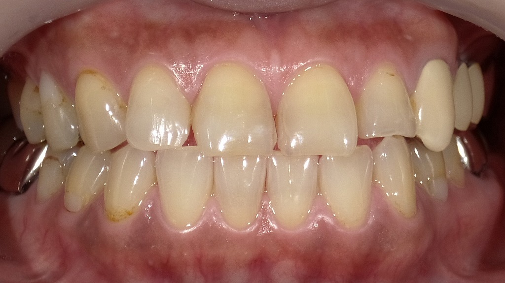 Before：全体的な黄ばみとステインが気になる状態