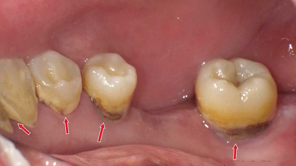 唾液が臭う原因は“歯石”かも？
口臭対策にはプロのクリーニングが必須