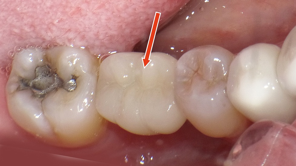 上部構造としてフルジルコニアクラウン