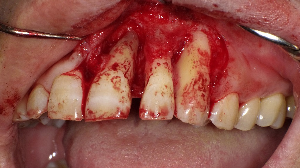 上顎前歯部におけるフラップ手術（歯周外科手術）