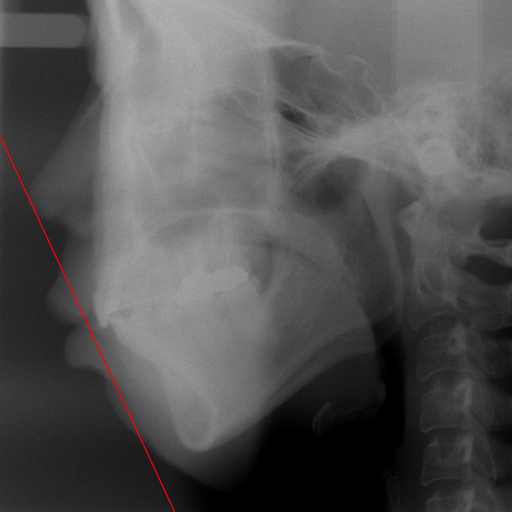 横顔のバランスは骨格で決まる？レントゲンでわかる横顔の特徴