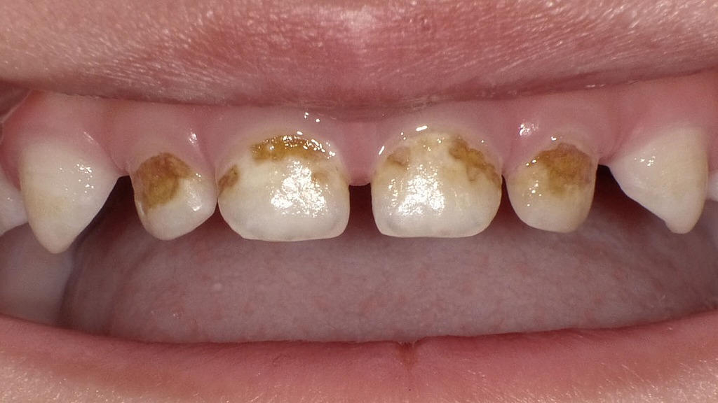 3歳児|歯磨き指導後に改善したプラーク付着の状態