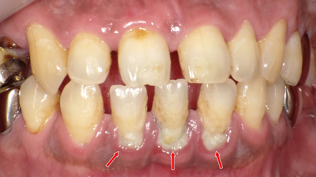 下顎前歯の根元に大量の歯石とプラークが付着し、歯周病が進行した状態