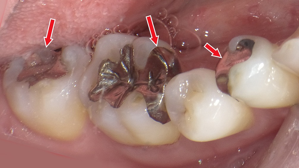 保険適用の銀歯の詰め物