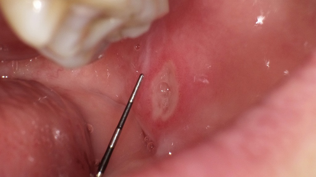 頬粘膜のアフタ性口内炎