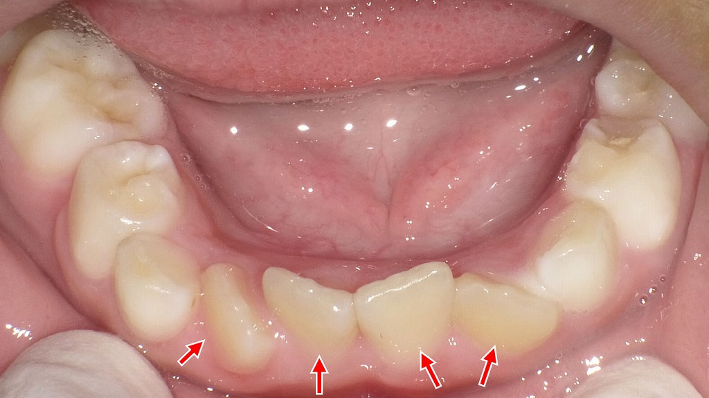 下顎永久前歯にみられる叢生(歯の重なり)(小児)