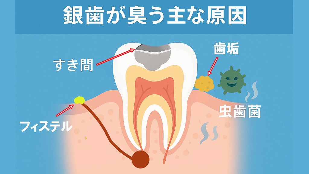 銀歯が臭う主な原因