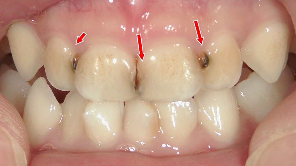 前歯の歯間に進行した虫歯(黒く見える部分)