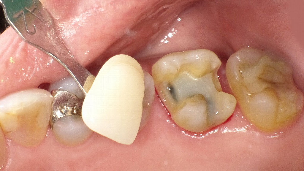 セラミックインレー治療｜形成完了とシェードテイキングの様子