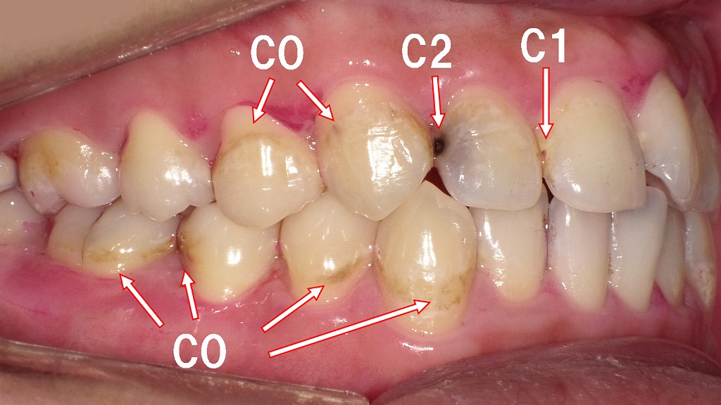 「CO」「C1」「C2」の虫歯症例