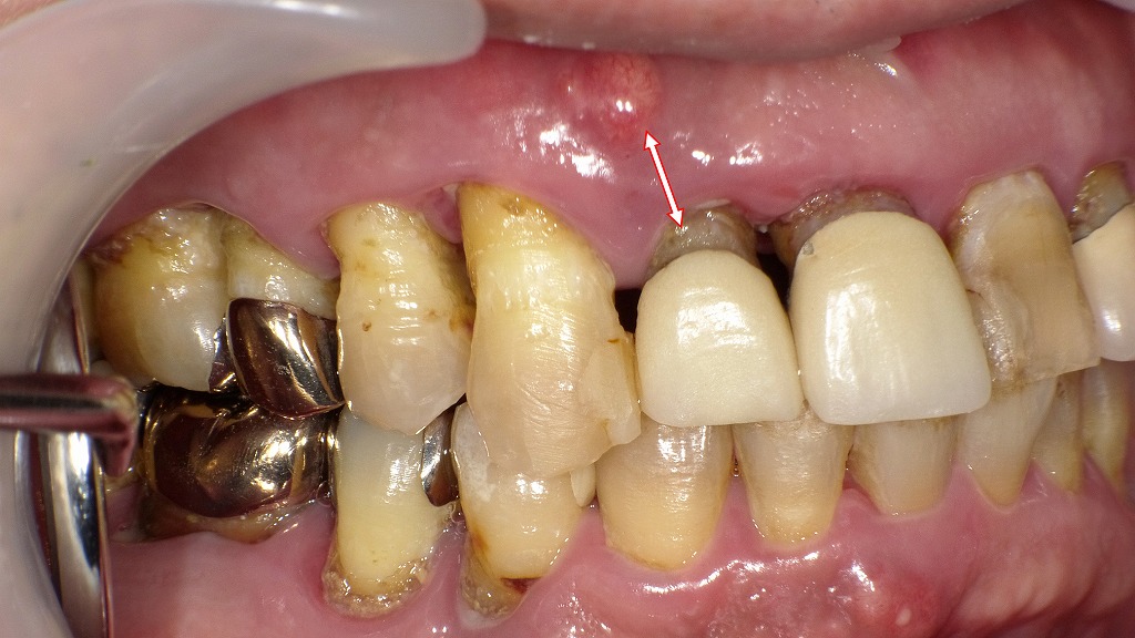 フィステルの症例