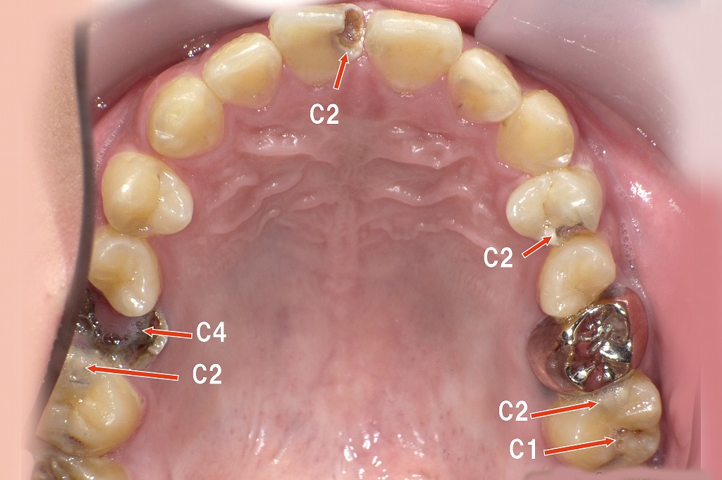 C（虫歯の進行度）