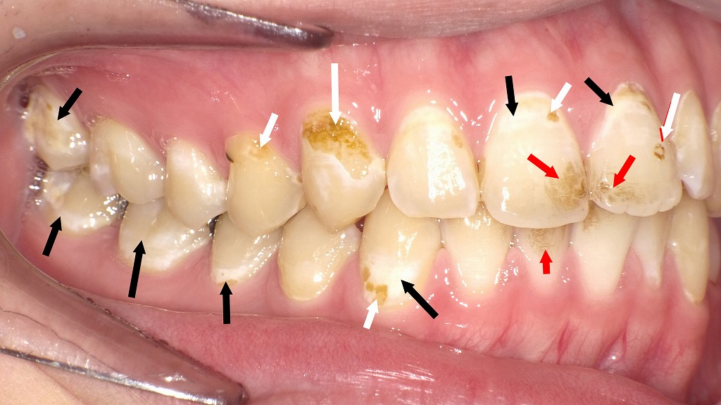 実際の口腔内所見