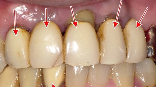 硬質レジン前装冠