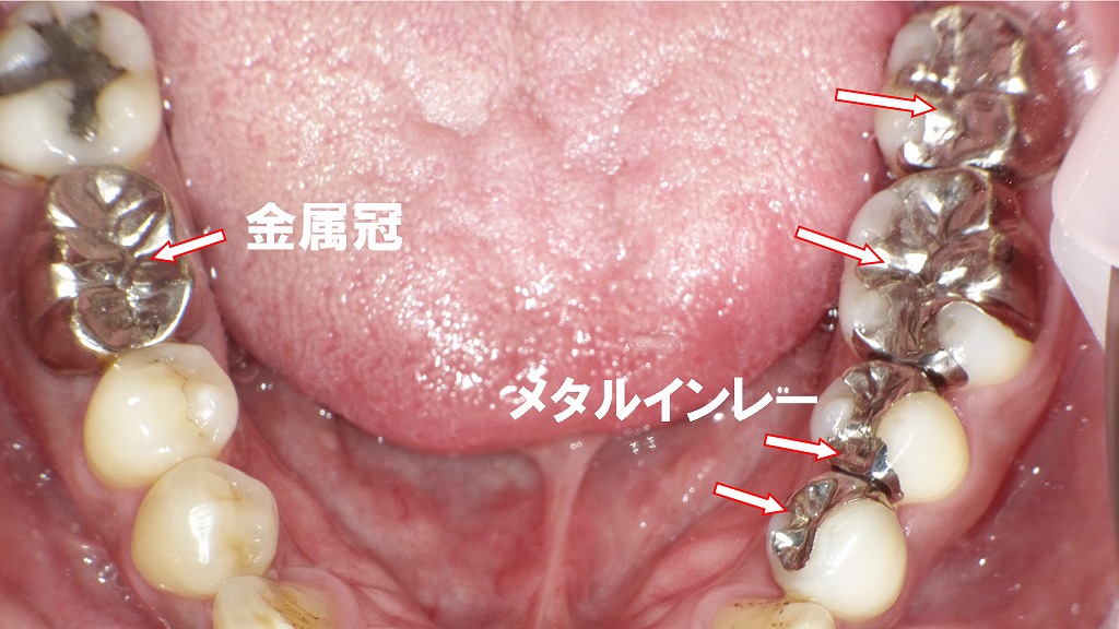 保険適用の銀歯（メタルインレー、金属冠）の症例