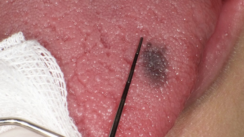 舌背に生じた黒色斑