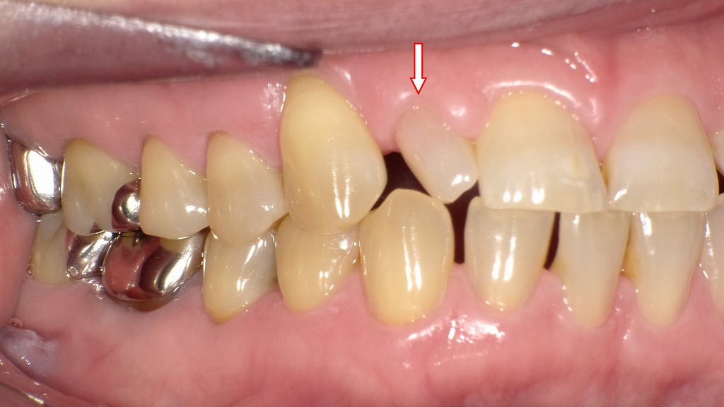 右側面観：歯が小さい症例