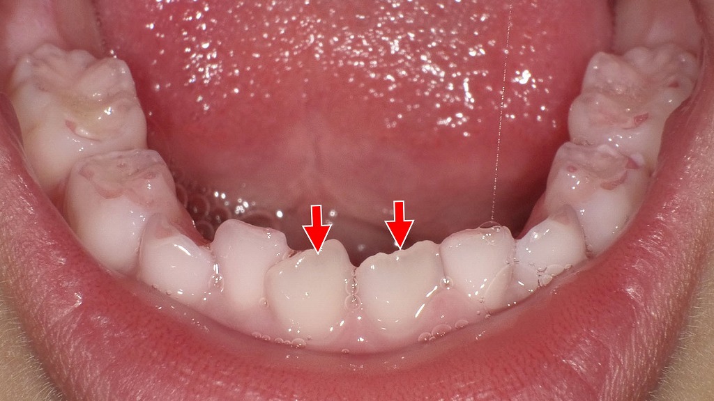 下顎前歯部における永久歯（矢印）の萌出スペース不足と軽度叢生を認める。