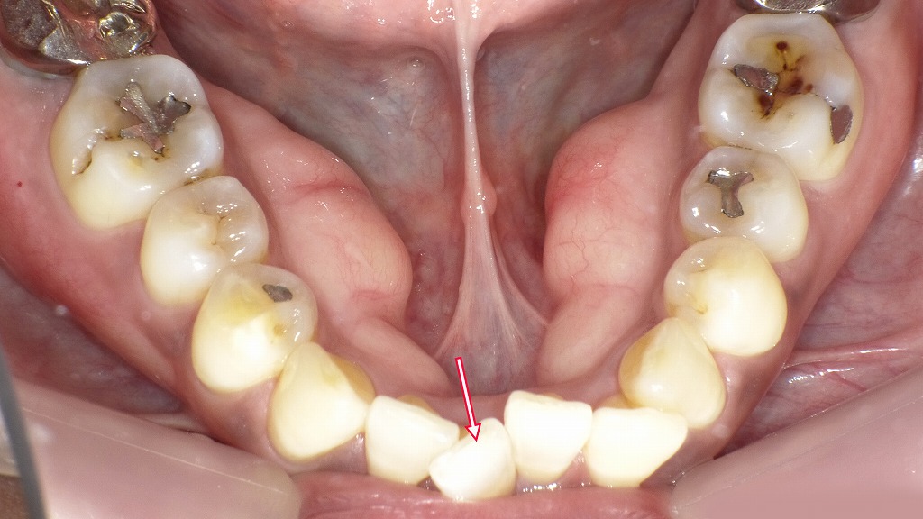 下の前歯がねじれて重なり合っている