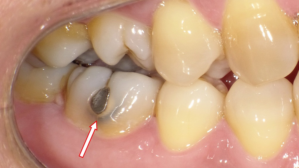 二次カリエスを起こしたアマルガム充填症例
