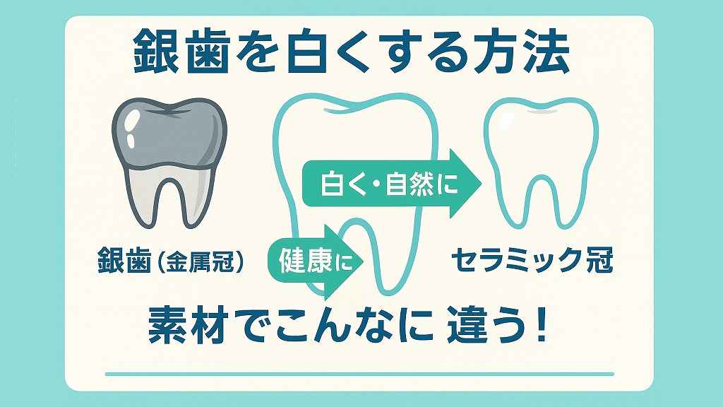 銀歯を白くする4つの主な方法