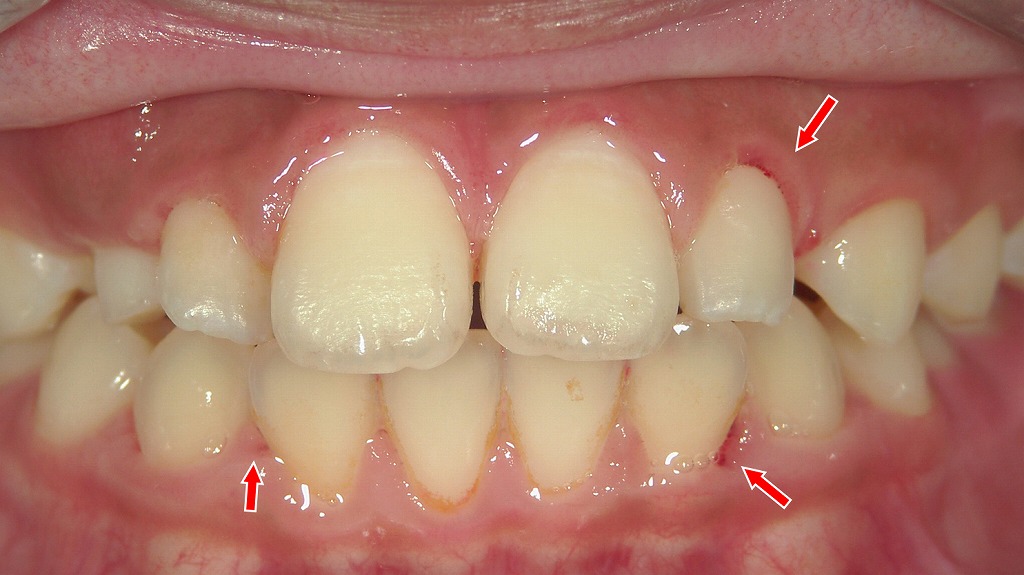 歯ぐきの炎症と軽度の自然出血が見られる状態(赤矢印部)