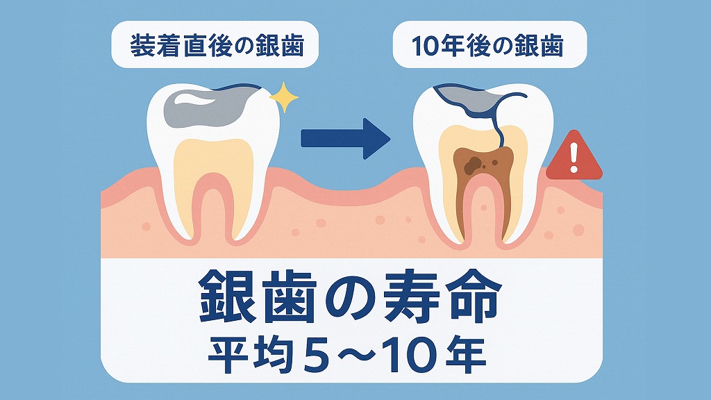 銀歯の寿命はどのくらい？