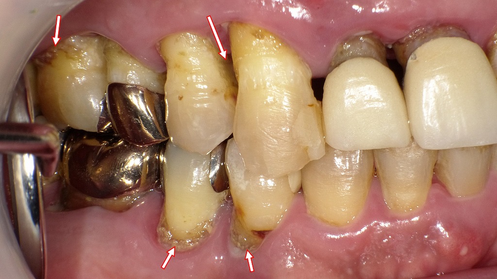 縁下歯石の症例