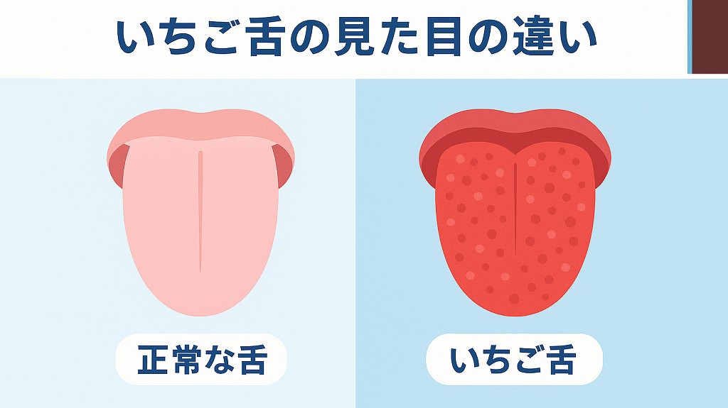 いちご舌とは?