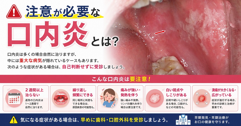注意が必要な口内炎
