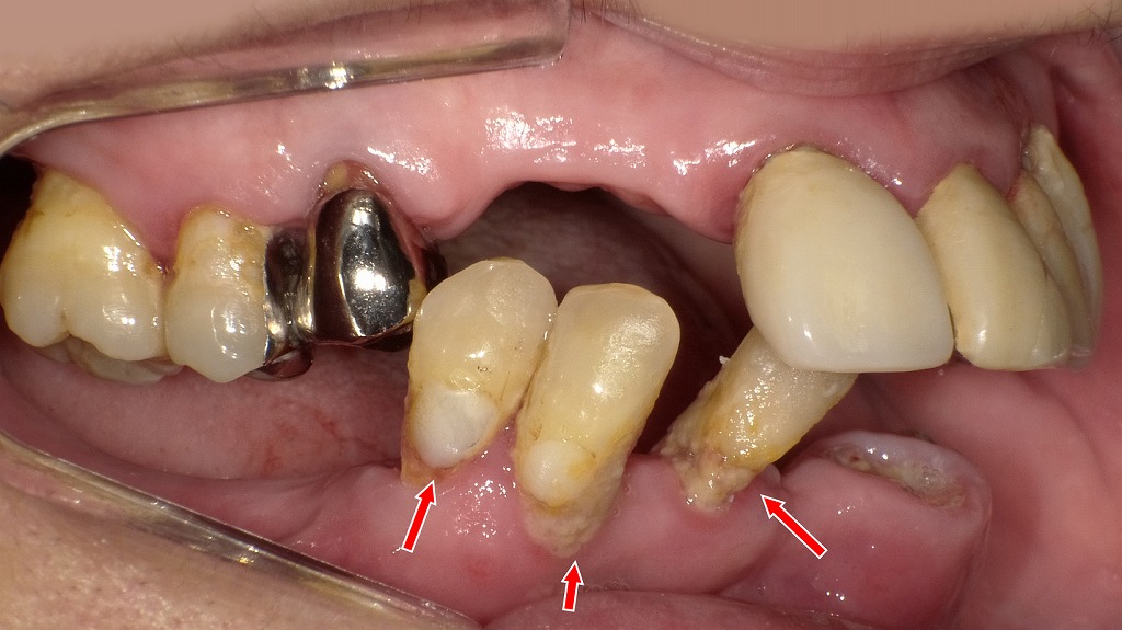 歯周病の進行度P4（重度歯周病）― 歯槽骨が著しく失われた状態